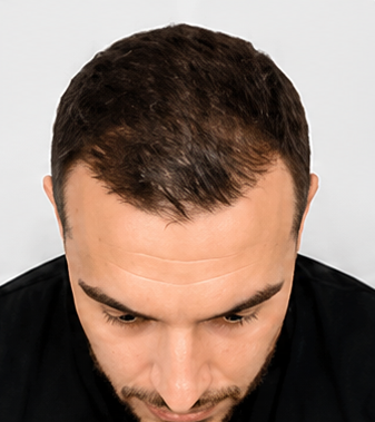 Hair tattoo after treatment improved hairline