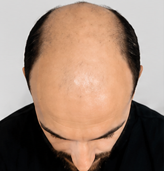 Scalp micro pigmentation results before treatment image one