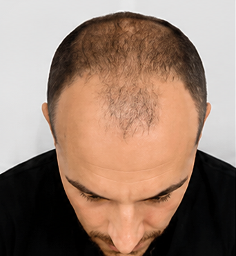 Hair tattoo before treatment crown thinning