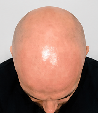 SMP before image for bald scalp